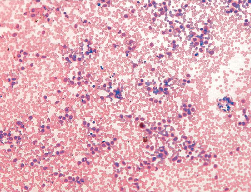 急性早幼粒细胞白血病-M3a型